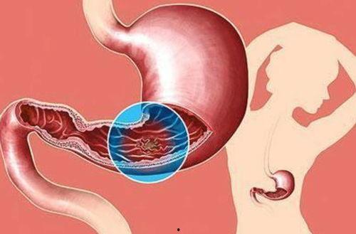 医生爆料切胃胃癌的视频,医生亲述惊心动魄的救治历程  第3张